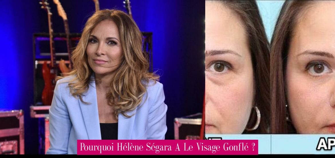 pourquoi-helene-segara-a-le-visage-gonfle