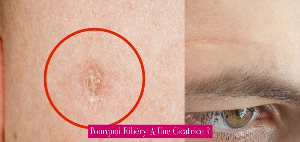 pourquoi-ribery-a-une-cicatrice